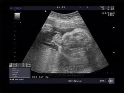 剖腹产两个女儿公婆还催着生,剖腹产婆婆让抱孩子老公不舍