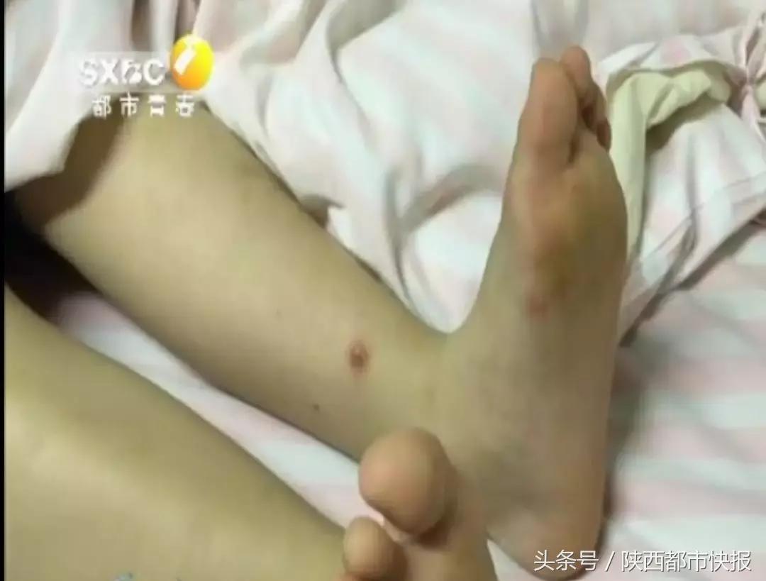 幼儿园手足口病应急处置方案,西安一幼儿园百余名儿童发烧呕吐