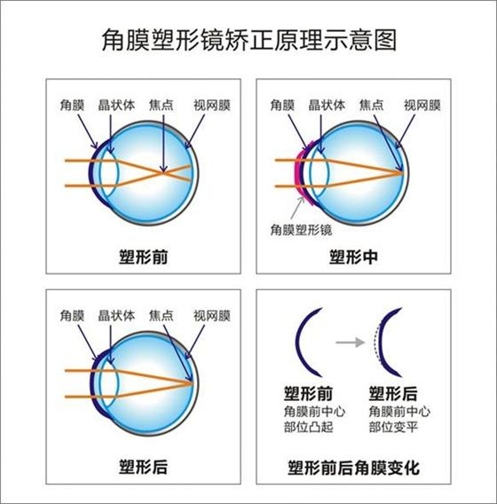 经常戴隐形眼镜有什么不好,为什么戴隐形眼镜一开始会辣眼睛