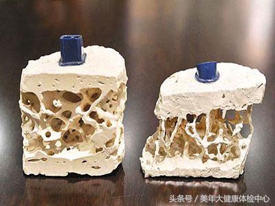 糖尿病骨质疏松怎么治疗效果好,糖尿病骨质疏松吃什么水果补得快
