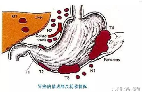 肿瘤最有可能长的地方在哪,肿瘤细胞在体内