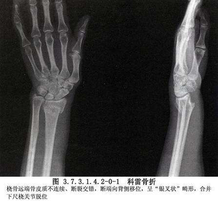 右手桡骨下端骨折几级伤残,桡骨中下段骨折手术疤痕