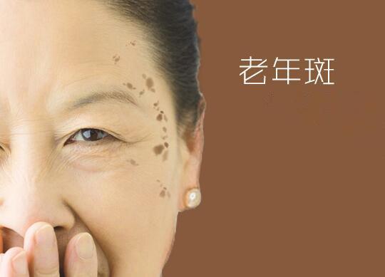 老年斑的最佳消除方法,老年斑不容易去除的原因