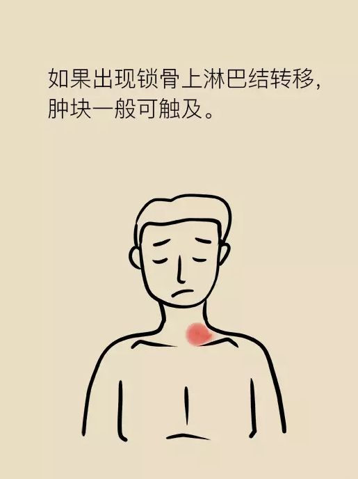 肝癌科普动画,肝癌的形成过程漫画
