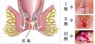 局部疼痛是痔疮吗,痔疮便秘肛裂反反复复