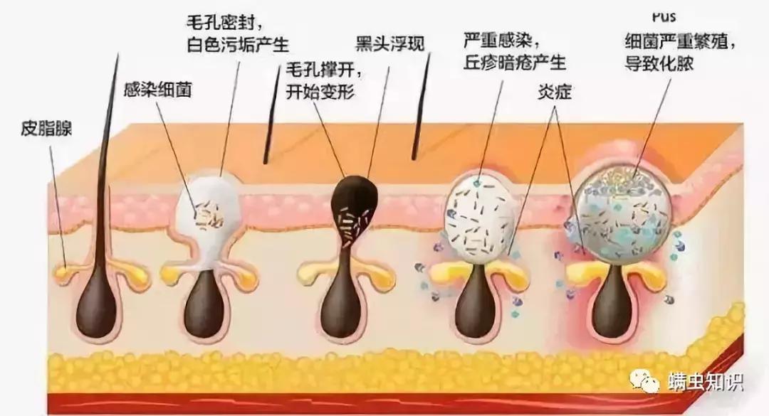 鼻子两侧黑头怎么处理,鼻子上有黑头应该注意些什么