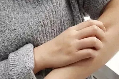 蚊子咬完红肿硬很大怎么样能止痒,被蚊子咬到眼睛最快消肿止痒妙招
