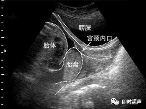 前置胎盘的孕妈妈,前置胎盘的宝妈宝宝会入盆吗
