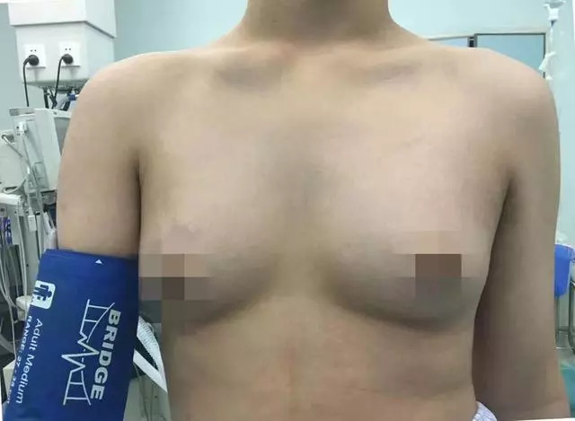 14岁男孩胸部达B*杯罩**，患癌率猛增几十倍，这些东西不能再吃了……