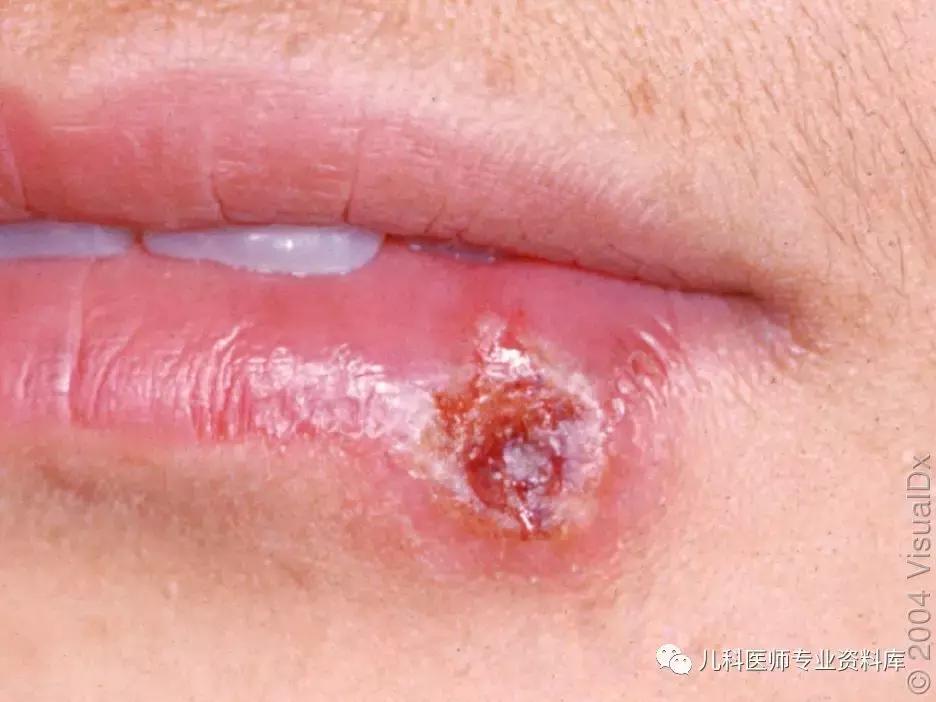 宝宝嘴巴上火的症状,宝宝嘴巴臭是积食还是上火