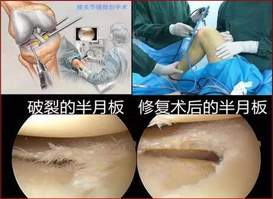 半月板治疗误区,半月板损伤一度的注意事项