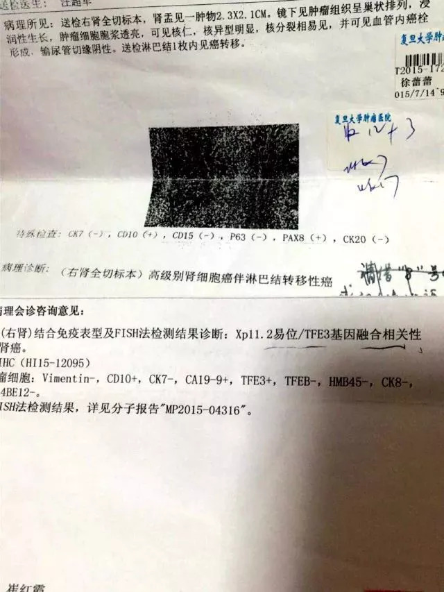 一名肺癌患者20年的抗癌经历,一位膀胱癌医生的真实抗癌经历