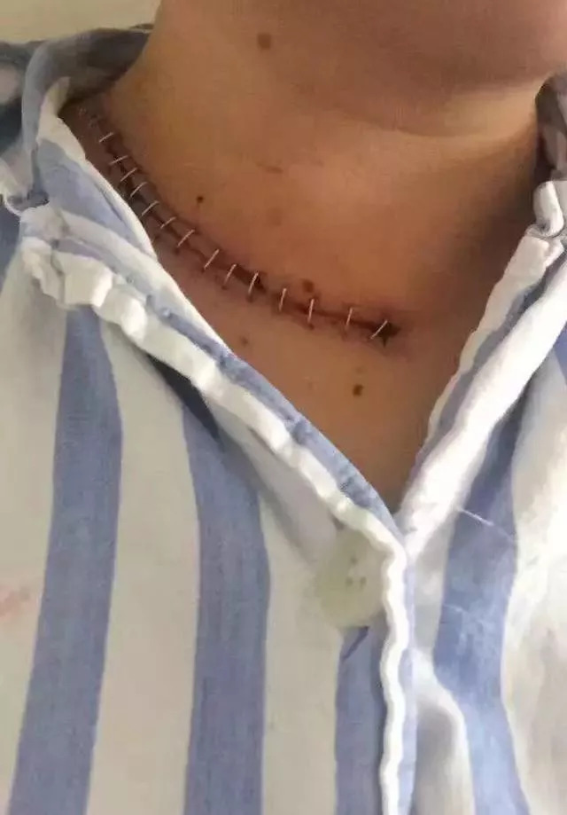 一名肺癌患者20年的抗癌经历,一位膀胱癌医生的真实抗癌经历