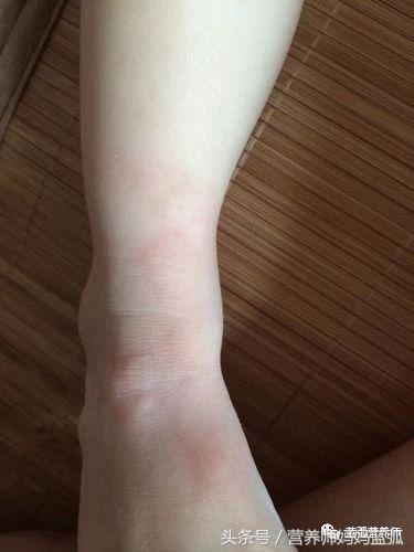 每5个人就有1个患寻麻疹，这样调理才能治本！