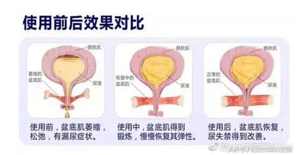 产后在家怎么做盆底肌康复,产后盆底肌康复训练视频教程