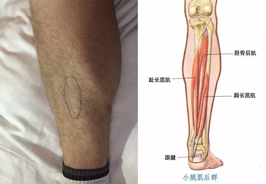 跟腱疼痛的康复与预防,跟腱康复训练最佳方法视频教程