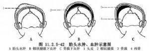 宝宝一出生头上就长这种瘤怎么办！如何识别良性OR恶性？