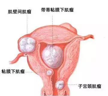 月经过多的原因是什么呢,月经过多针灸穴位