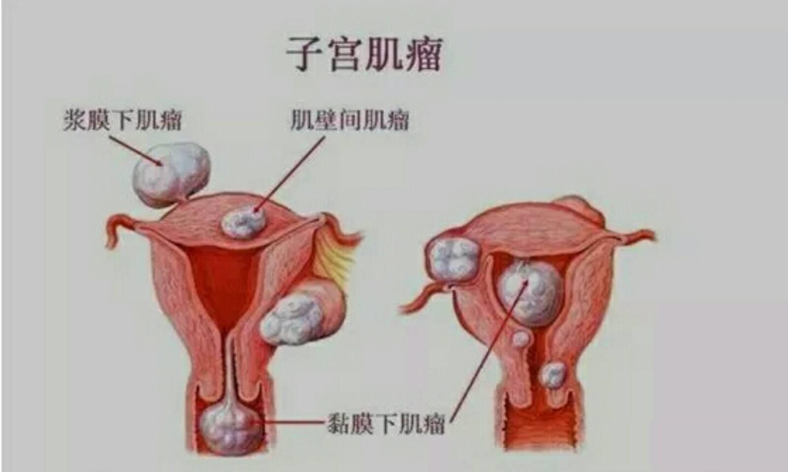 子宫肌瘤对怀孕的影响有多大？需要做手术吗？