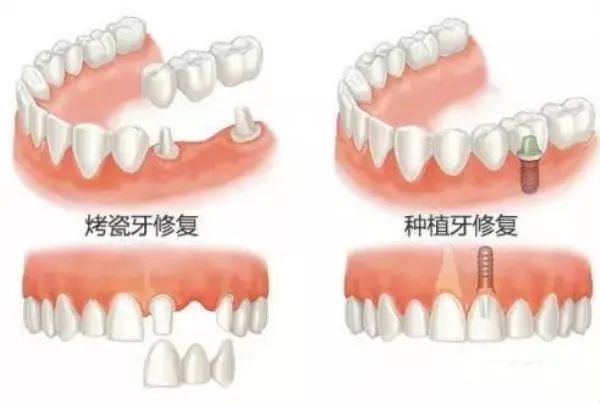 什么情况下牙齿需要做牙冠,牙齿抽掉神经需要戴牙冠吗