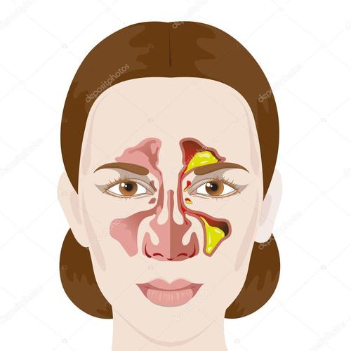 鼻内镜住院注意事项,鼻内镜手术后多久可以下床