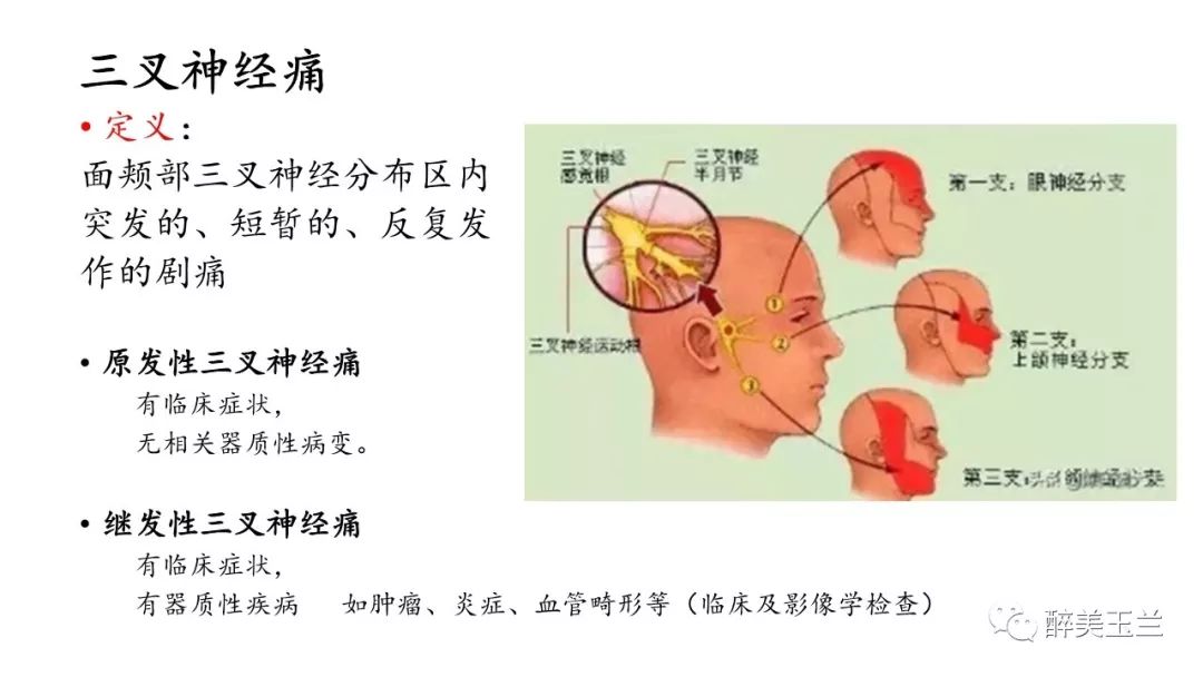 病例分享丨三叉神经节微球囊压迫术的麻醉管理
