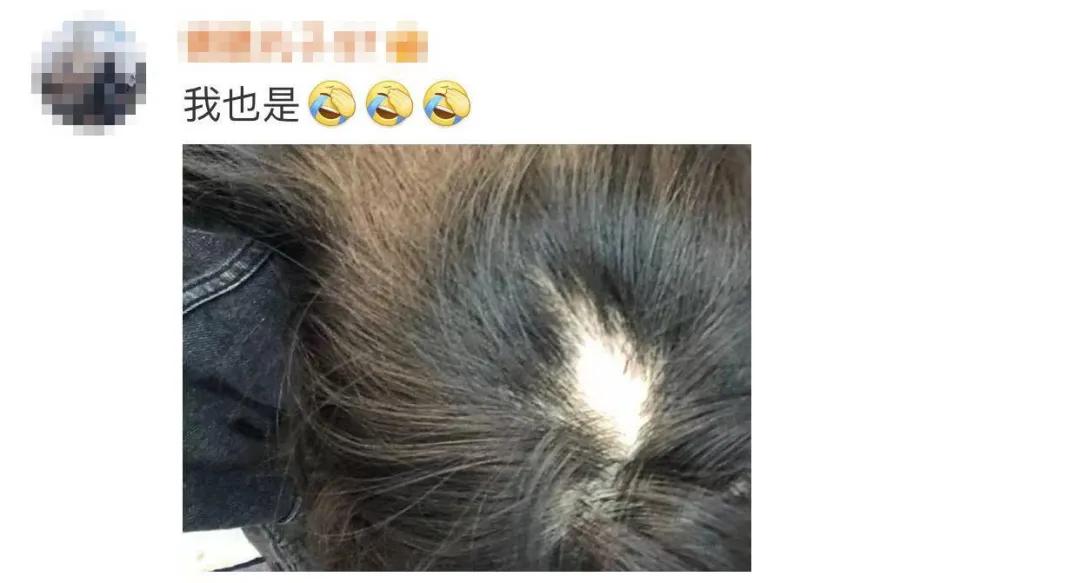 美女主持人突然上热搜，网友纷纷晒同款！脱发原来是毛囊“休息”了