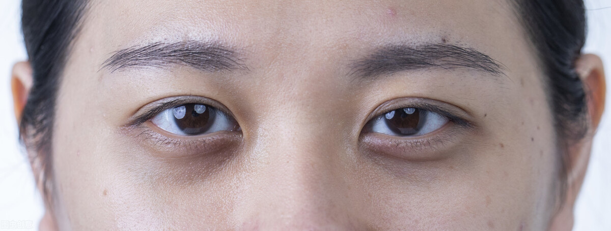 眼袋一笑就变成卧蚕了,祛除眼袋能保留卧蚕吗