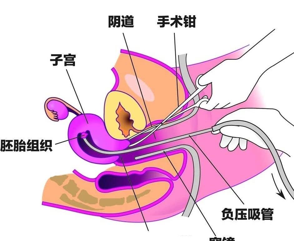 做过人工流产还会怀孕吗,女性流产过能检查出来吗