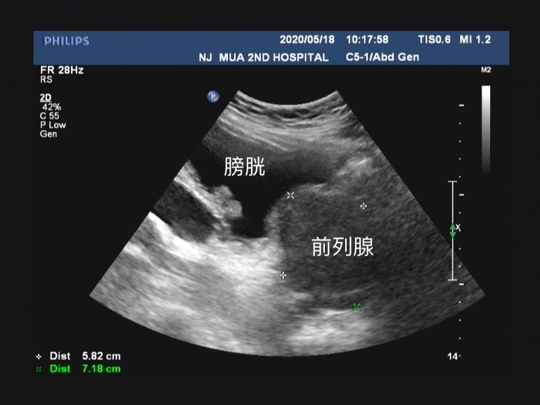 治疗前列腺增生什么方法最靠谱,前列腺增生何种方式治疗效果最好