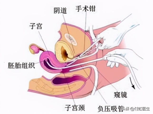 人流术后月经来10几天不干净,人流术后三个月内膜薄例假不来