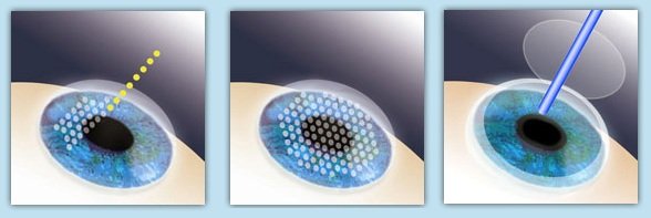 近视眼激光手术后20年后的后遗症,权威讲解近视眼手术的利弊