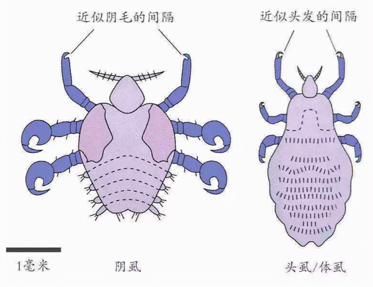 七八十年代人人头上有虱子,80年代时人们为什么会有虱子