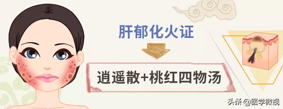 满脸痘痘怎么治不花钱,满脸痘痘中药调理效果如何