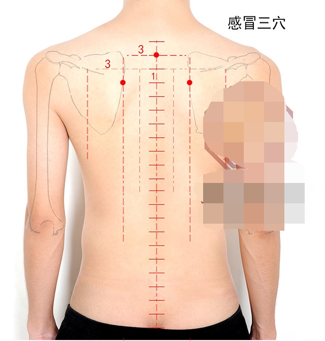 上呼吸道感染症状针灸穴位,上呼吸道感染针灸哪里效果最好
