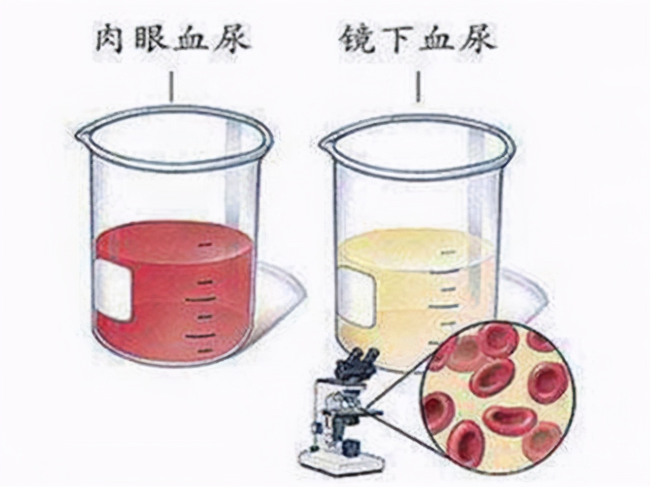 高血压会引起尿检隐血吗,高血压尿潜血是肾炎吗