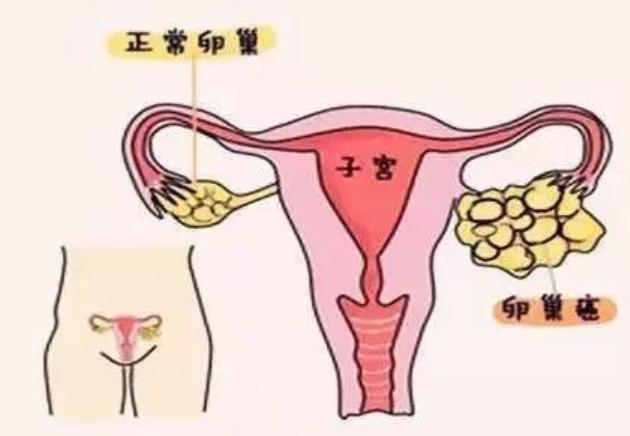 关于卵巢癌，你想知道的都在这里了