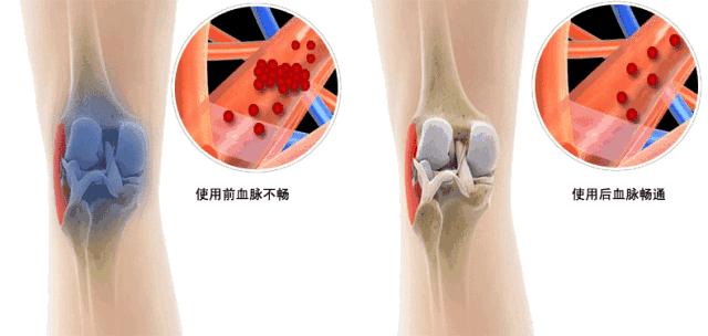 膝盖废了会怎么样,不想膝盖废了就来看看