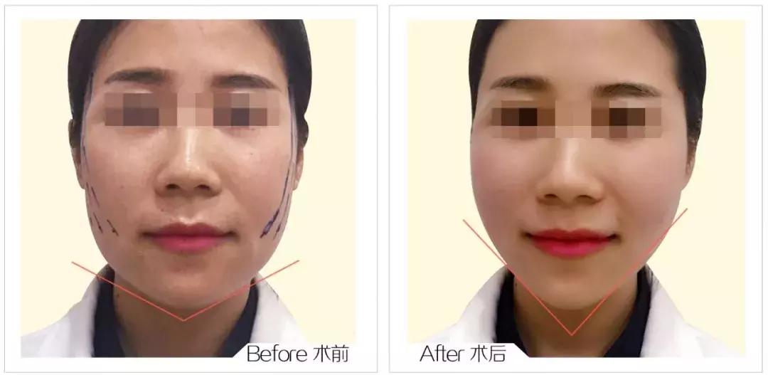 线雕加玻尿酸可以保多长时间,玻尿酸加线雕隆鼻能半永久吗