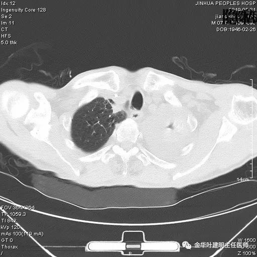 手术引起乳糜胸,有没有做了肺结节手术后是误诊的