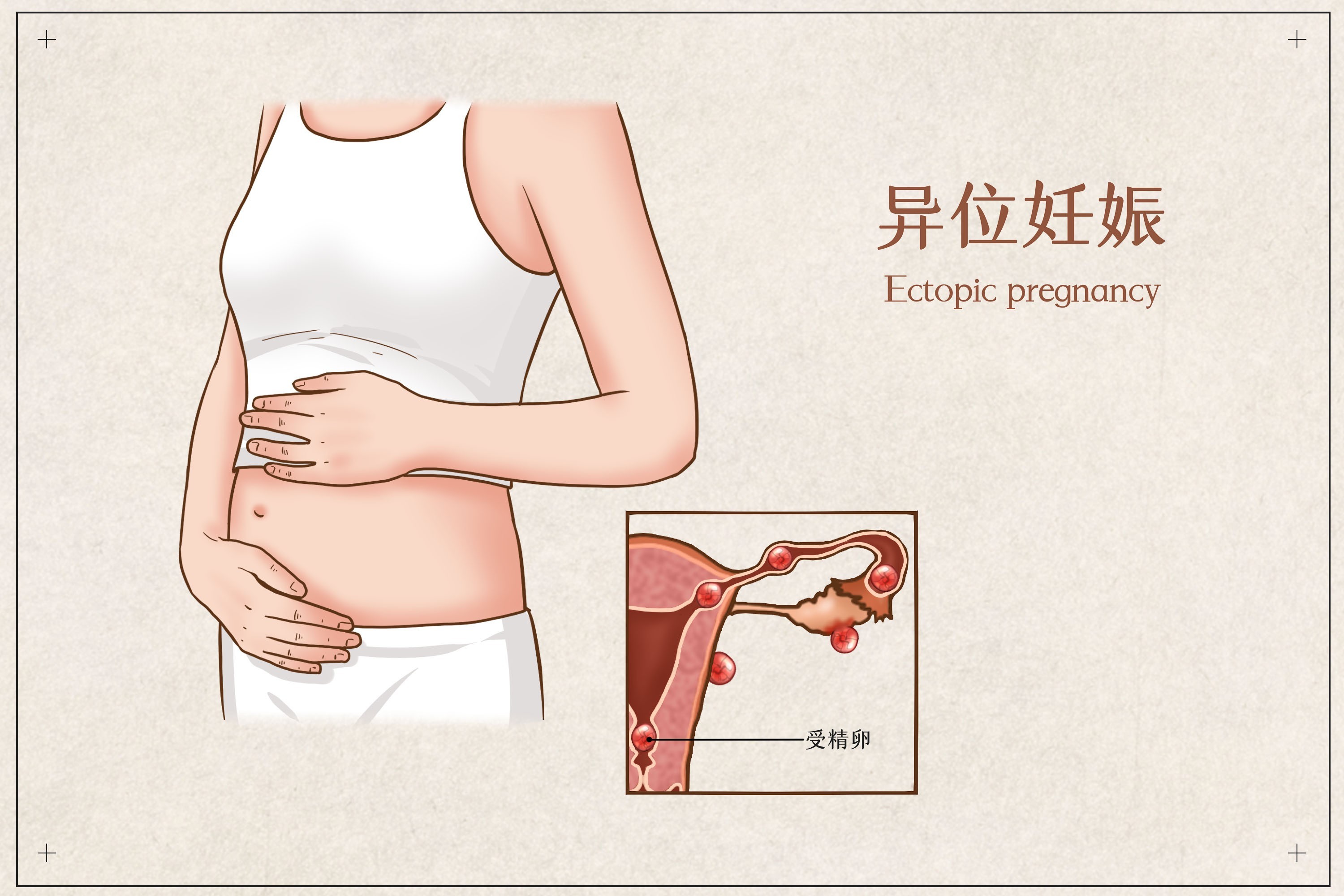 什么是异位妊娠？异位妊娠都有哪些表现？备孕女性要清楚