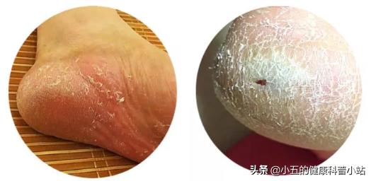 辨证论治，内外皆用，聊一聊中医治疗足癣病的用药思路
