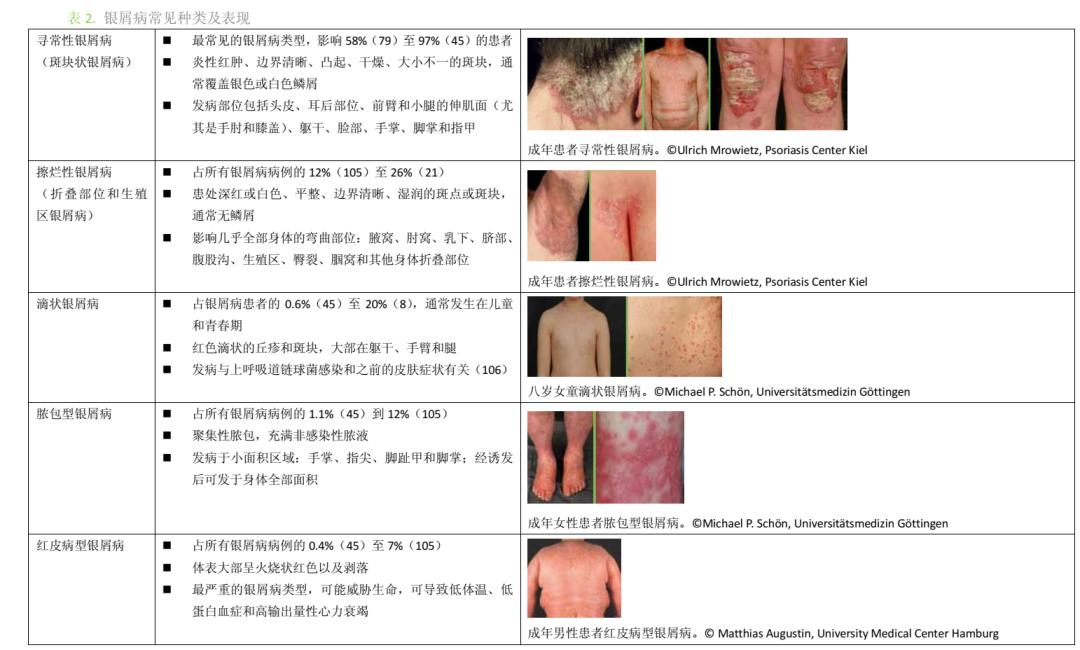 尿布疹会引起哪些症状呢,顽固性尿布疹能引起银屑病吗