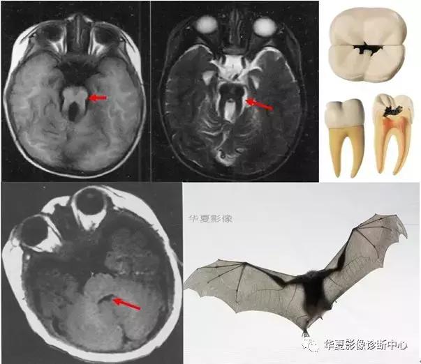 颅脑核磁影像解剖图谱,颅脑mr增强影像图片