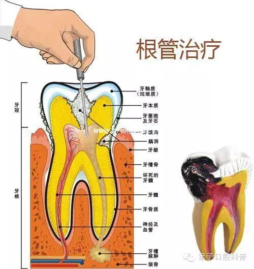 蛀牙疼是拔还是补,蛀牙痛还是拔智齿痛