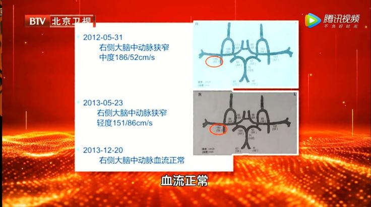 没做手术逆转动脉斑块！医生给了一个方案，坚持2年大大改善