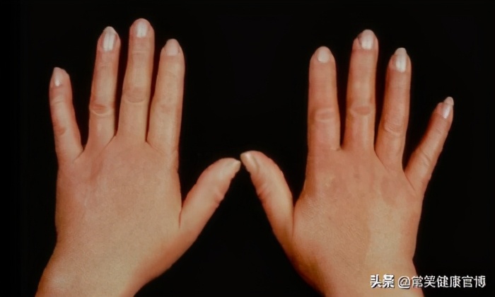 硬皮病是软组织增厚变硬的病吗,皮肤增厚发硬像茧子一样