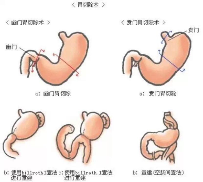 胃癌手术方式有哪几种,胃癌手术要多少钱