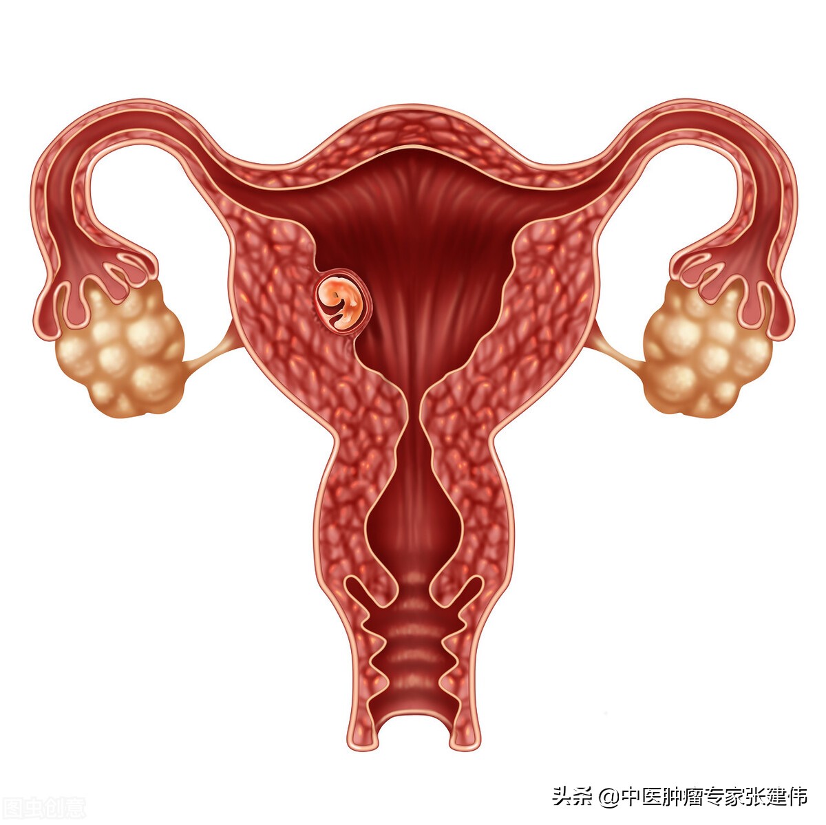 每个女人都会子宫肌瘤吗,5个子宫肌瘤会癌变吗