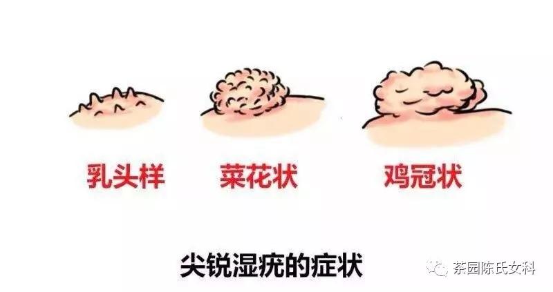 严重的尖锐性湿疣能治好吗,尖锐性湿疣哪型最严重